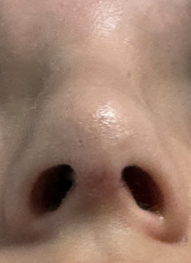 Rhinoplasty Before & After Gallery - Patient 106401 - Image 12