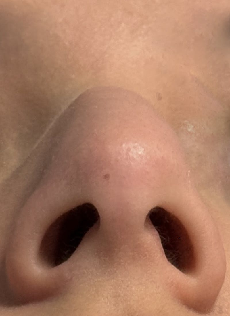 Rhinoplasty Before & After Gallery - Patient 106401 - Image 11