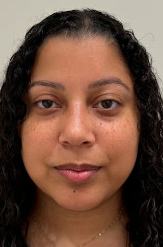 Rhinoplasty Before & After Gallery - Patient 264561 - Image 2