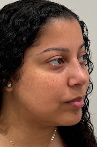Rhinoplasty Before & After Gallery - Patient 264561 - Image 4