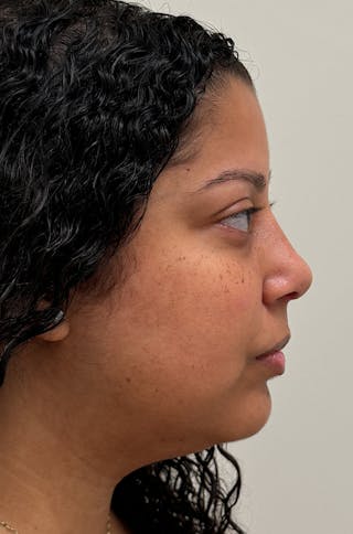 Rhinoplasty Before & After Gallery - Patient 264561 - Image 6