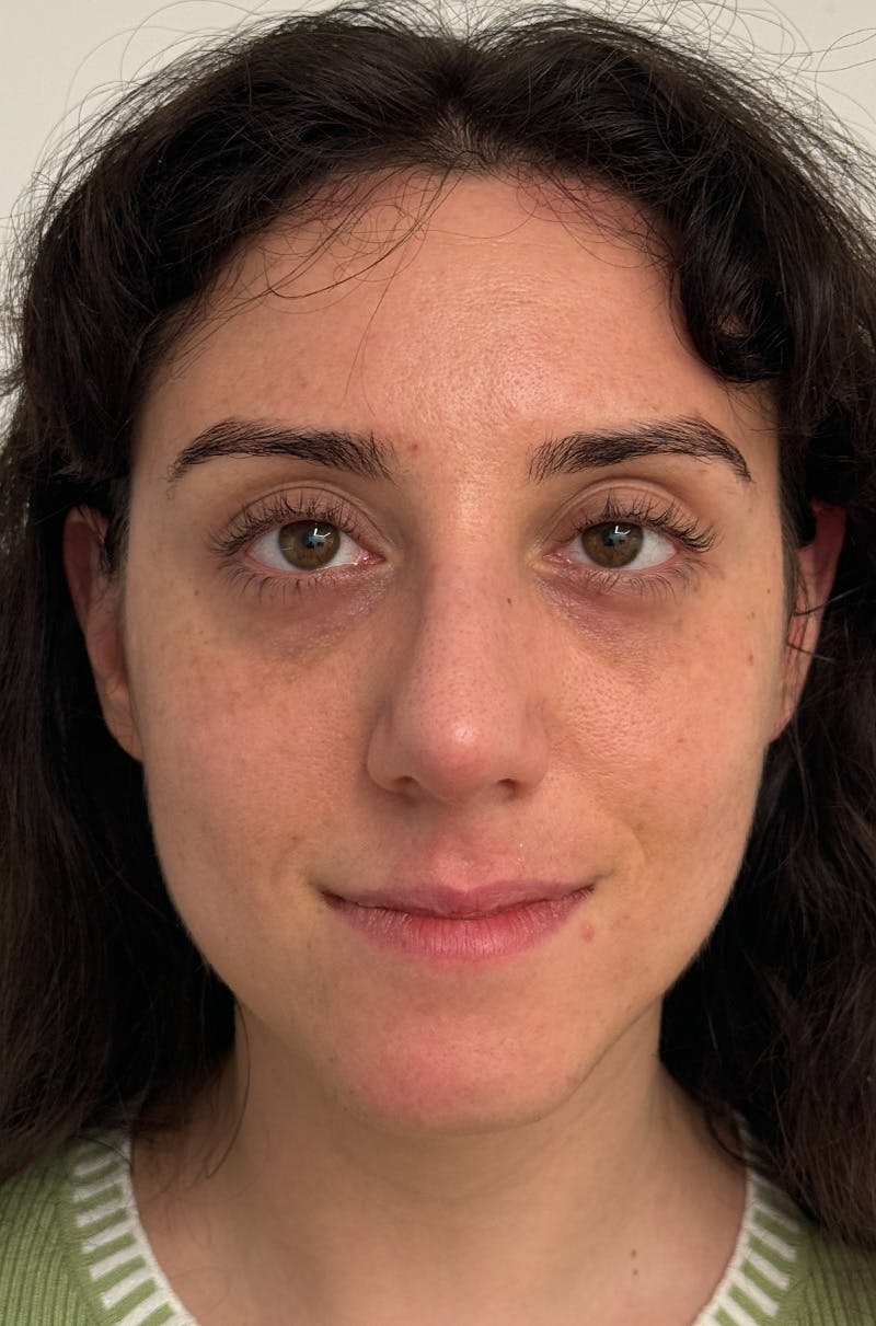 Rhinoplasty Before & After Gallery - Patient 583013 - Image 2