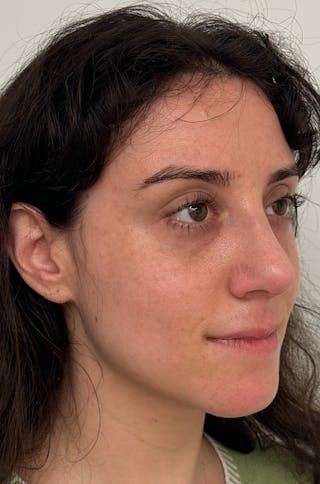 Rhinoplasty Before & After Gallery - Patient 583013 - Image 4