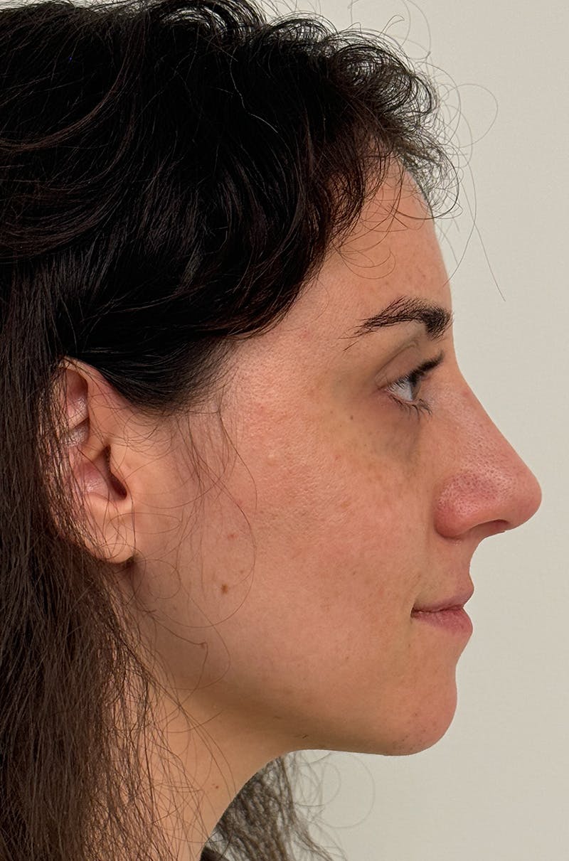 Rhinoplasty Before & After Gallery - Patient 583013 - Image 6