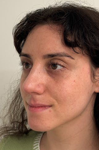 Rhinoplasty Before & After Gallery - Patient 583013 - Image 8