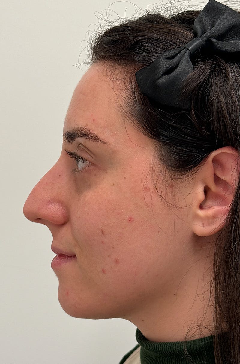 Rhinoplasty Before & After Gallery - Patient 583013 - Image 9