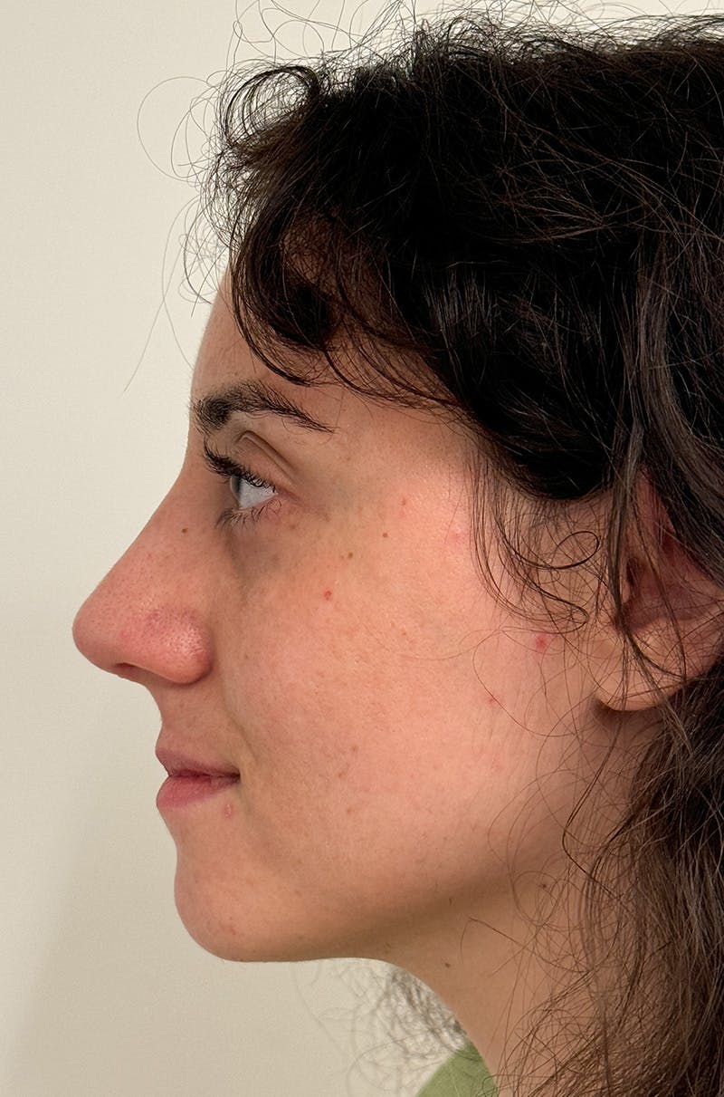 Rhinoplasty Before & After Gallery - Patient 583013 - Image 10
