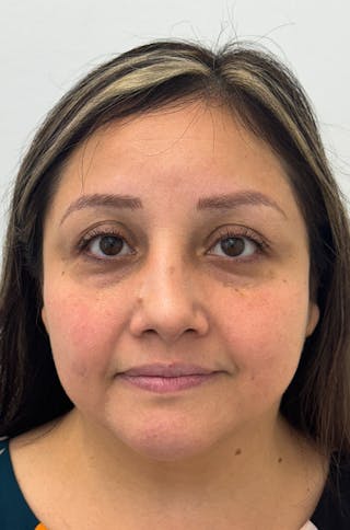 Rhinoplasty Before & After Gallery - Patient 505031 - Image 2