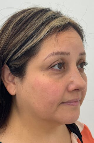 Rhinoplasty Before & After Gallery - Patient 505031 - Image 4