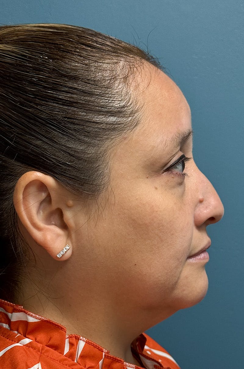 Rhinoplasty Before & After Gallery - Patient 505031 - Image 5