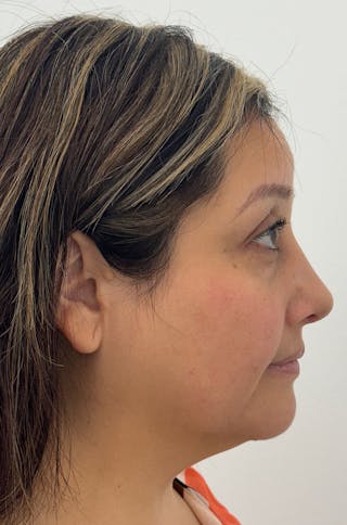 Rhinoplasty Before & After Gallery - Patient 505031 - Image 6