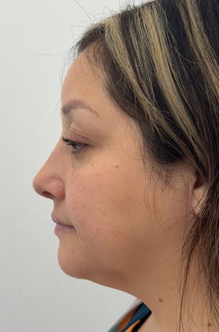 Rhinoplasty Before & After Gallery - Patient 505031 - Image 8