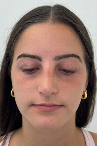 Rhinoplasty Before & After Gallery - Patient 196347 - Image 2