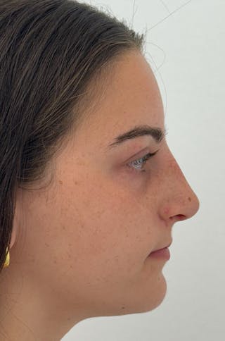 Rhinoplasty Before & After Gallery - Patient 196347 - Image 4