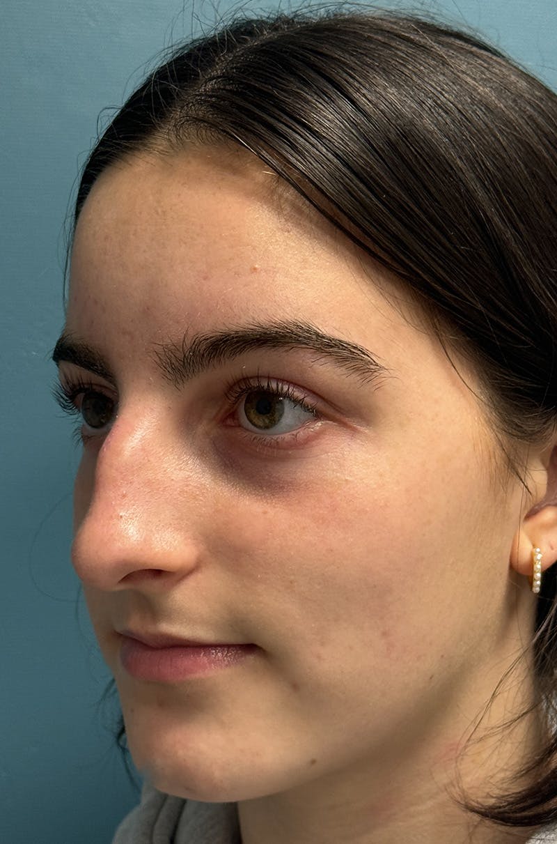 Rhinoplasty Before & After Gallery - Patient 196347 - Image 5