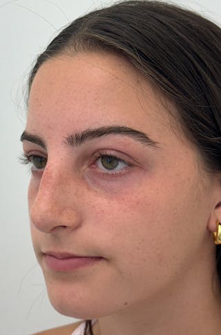 Rhinoplasty Before & After Gallery - Patient 196347 - Image 6