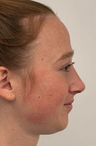 Rhinoplasty Before & After Gallery - Patient 171572 - Image 6