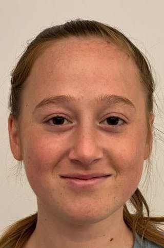 Rhinoplasty Before & After Gallery - Patient 171572 - Image 2