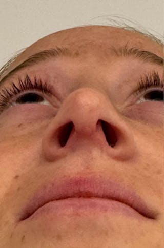 Rhinoplasty Before & After Gallery - Patient 171572 - Image 12