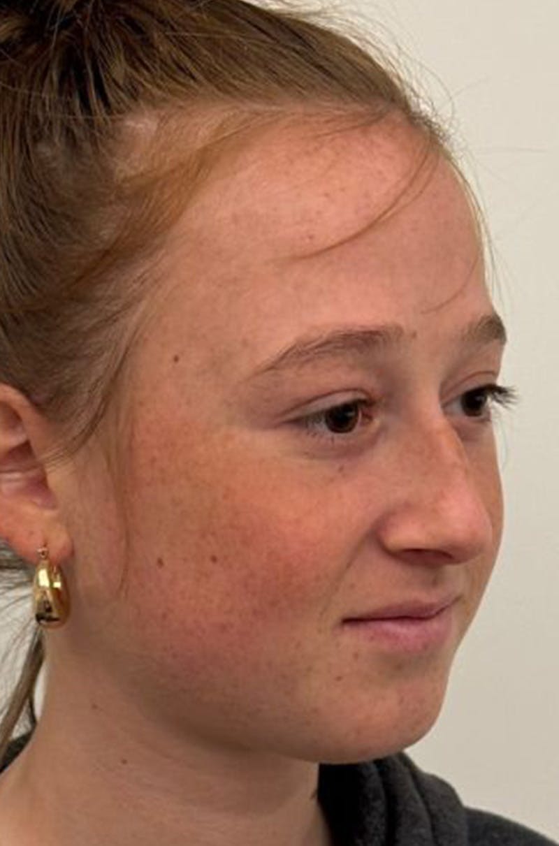 Rhinoplasty Before & After Gallery - Patient 171572 - Image 3