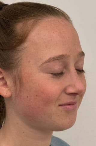 Rhinoplasty Before & After Gallery - Patient 171572 - Image 4