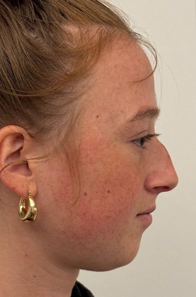 Rhinoplasty Before & After Gallery - Patient 171572 - Image 5