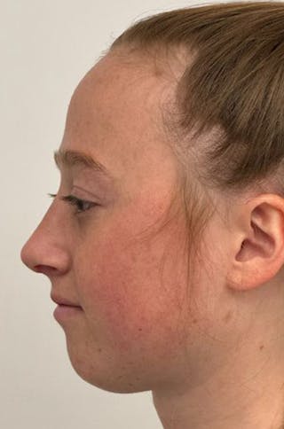 Rhinoplasty Before & After Gallery - Patient 171572 - Image 10
