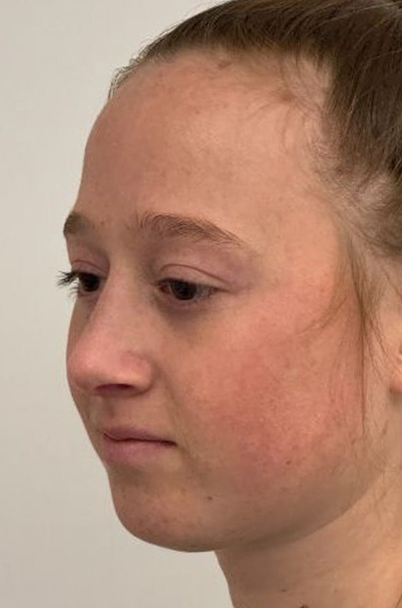 Rhinoplasty Before & After Gallery - Patient 171572 - Image 8