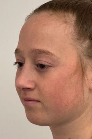 Rhinoplasty Before & After Gallery - Patient 171572 - Image 8