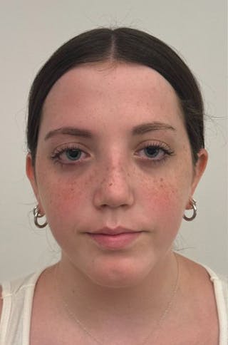 Rhinoplasty Before & After Gallery - Patient 580204 - Image 2