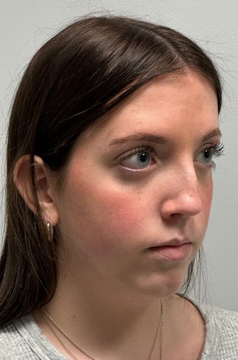 Rhinoplasty Before & After Gallery - Patient 580204 - Image 3