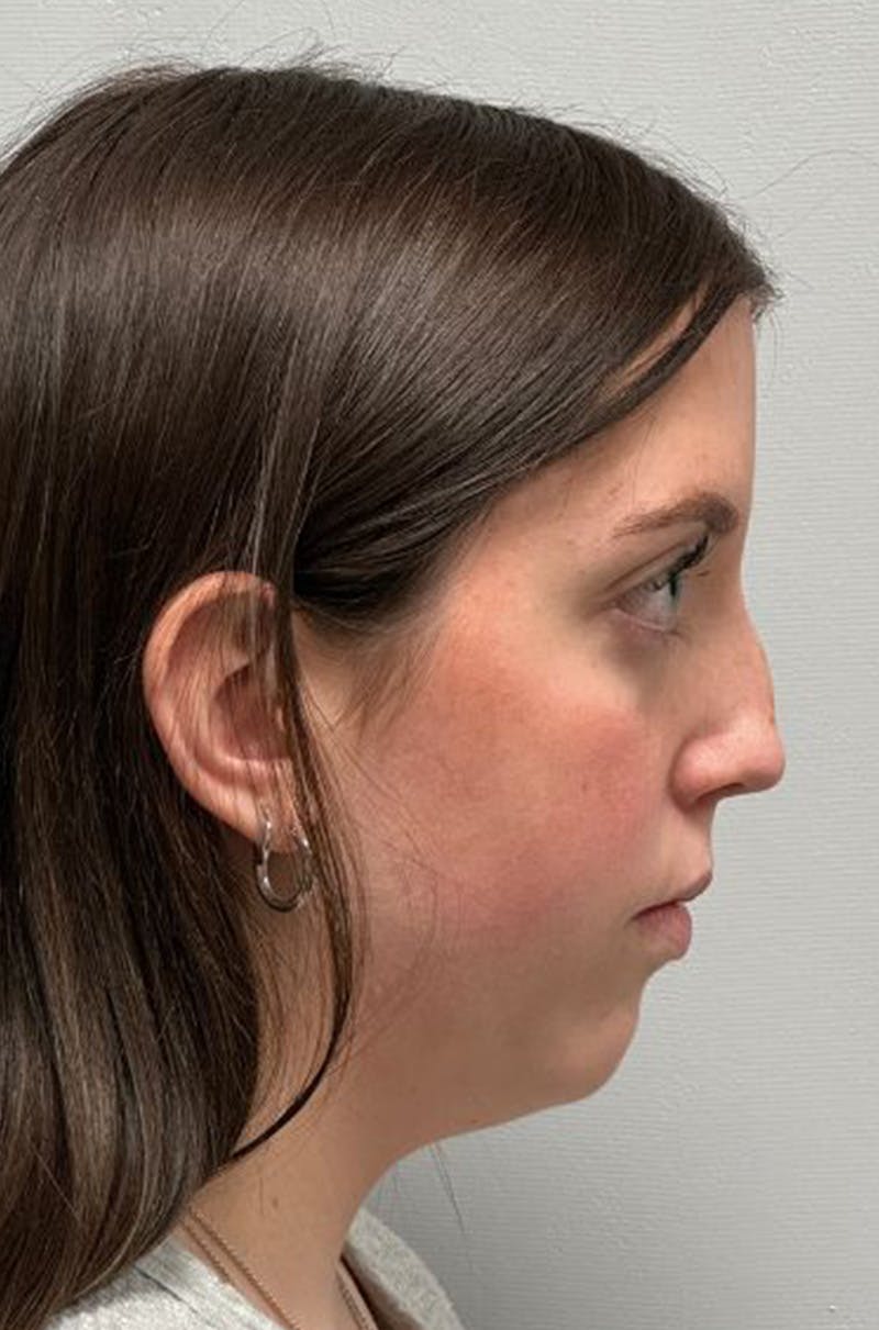 Rhinoplasty Before & After Gallery - Patient 580204 - Image 5