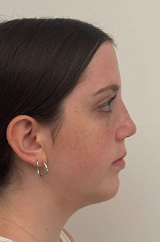 Rhinoplasty Before & After Gallery - Patient 580204 - Image 6