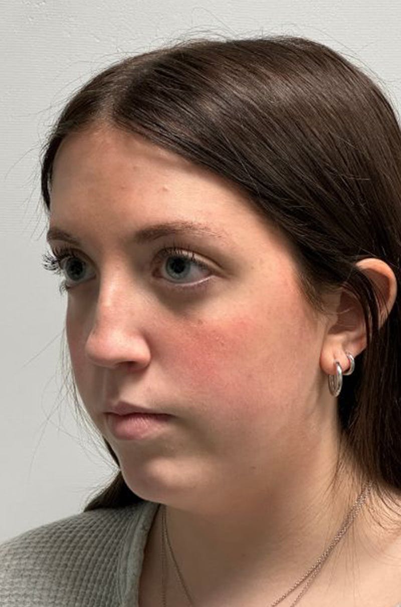 Rhinoplasty Before & After Gallery - Patient 580204 - Image 7