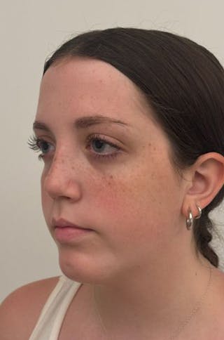 Rhinoplasty Before & After Gallery - Patient 580204 - Image 8
