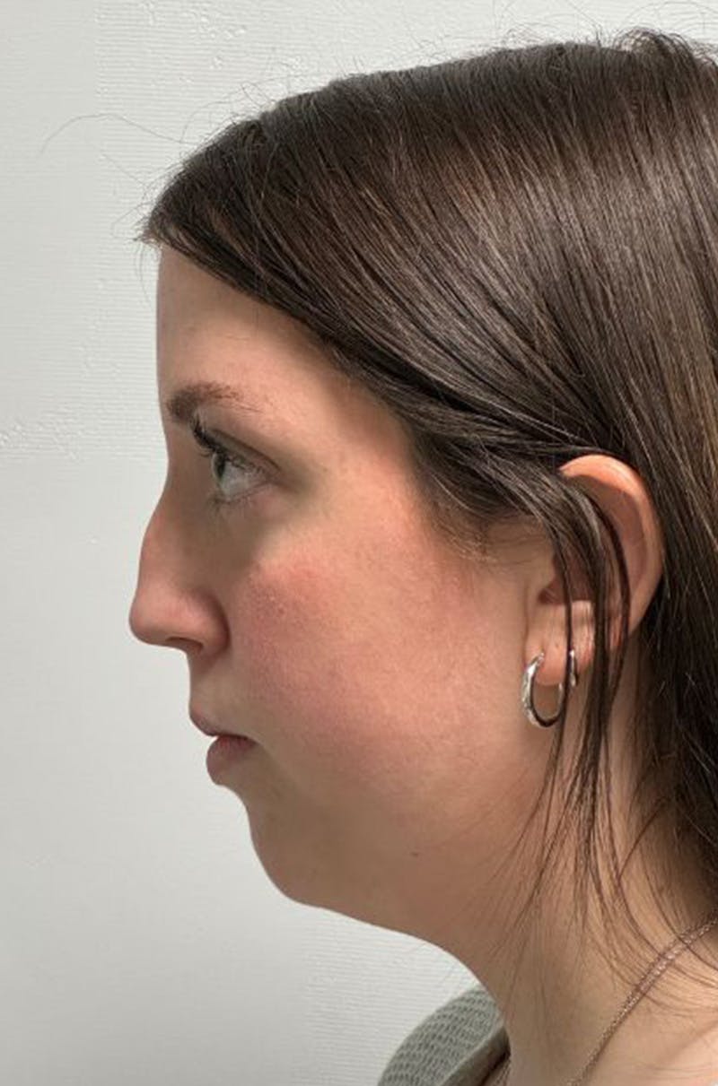 Rhinoplasty Before & After Gallery - Patient 580204 - Image 9