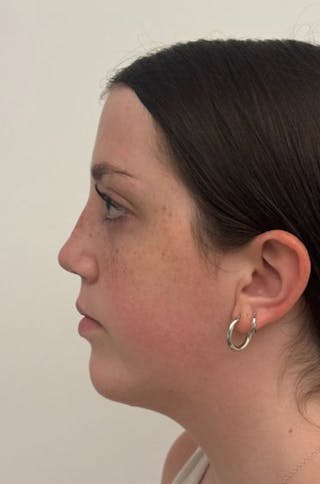 Rhinoplasty Before & After Gallery - Patient 580204 - Image 10