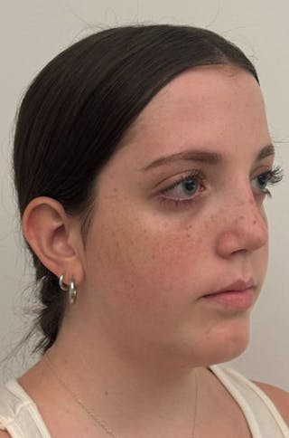 Rhinoplasty Before & After Gallery - Patient 580204 - Image 4