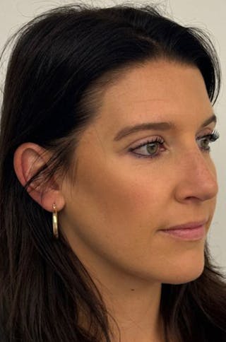 Rhinoplasty Before & After Gallery - Patient 272234 - Image 2