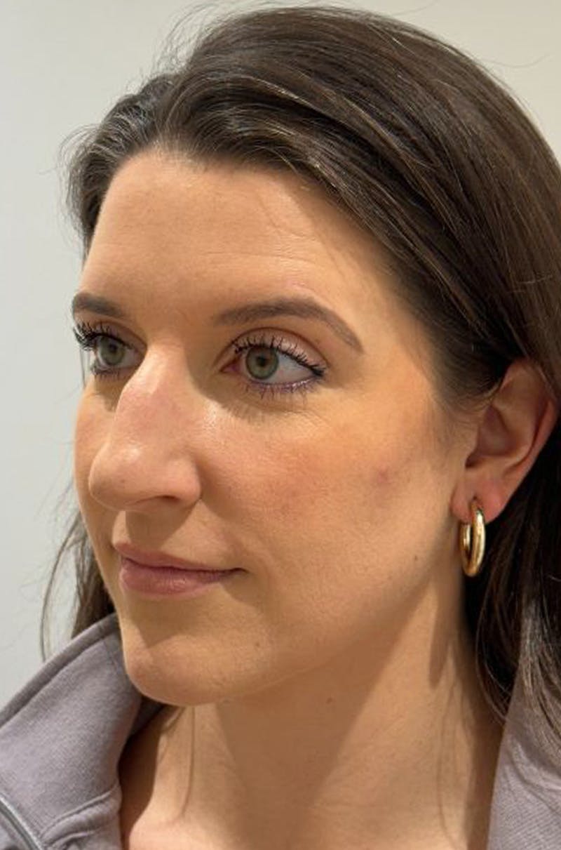 Rhinoplasty Before & After Gallery - Patient 272234 - Image 5