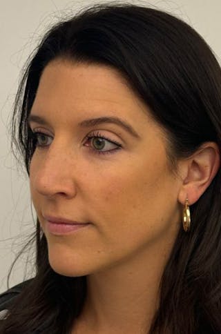 Rhinoplasty Before & After Gallery - Patient 272234 - Image 6