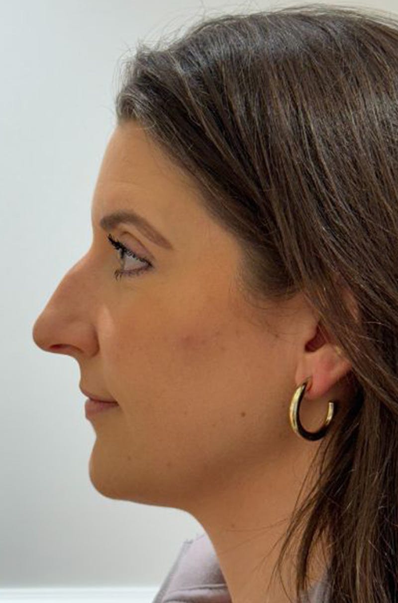 Rhinoplasty Before & After Gallery - Patient 272234 - Image 7
