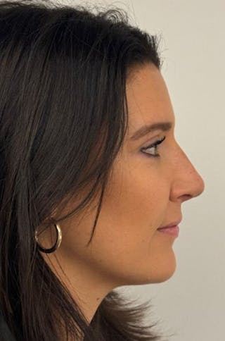 Rhinoplasty Before & After Gallery - Patient 272234 - Image 4