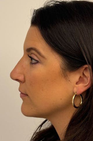 Rhinoplasty Before & After Gallery - Patient 272234 - Image 8