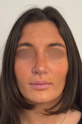 Rhinoplasty Before & After Gallery - Patient 336872 - Image 2