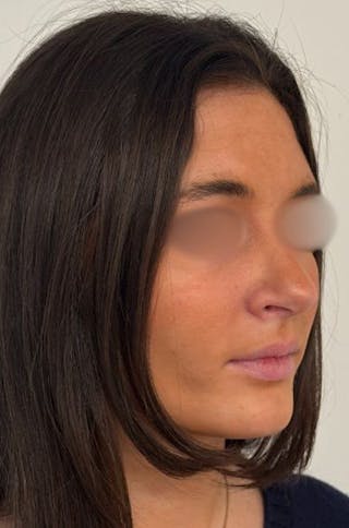 Rhinoplasty Before & After Gallery - Patient 336872 - Image 4