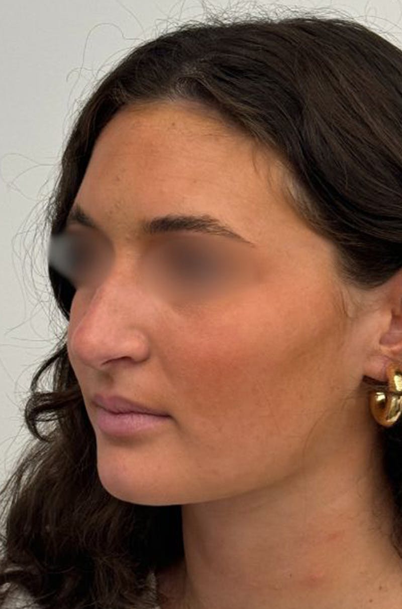 Rhinoplasty Before & After Gallery - Patient 336872 - Image 7
