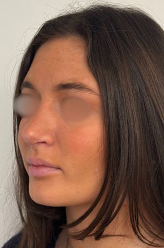 Rhinoplasty Before & After Gallery - Patient 336872 - Image 8