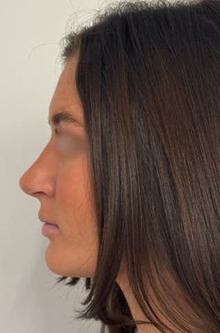 Rhinoplasty Before & After Gallery - Patient 336872 - Image 6