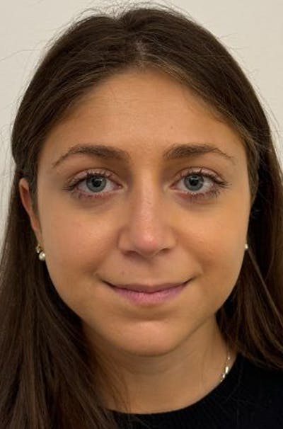 Rhinoplasty Before & After Gallery - Patient 389412 - Image 2